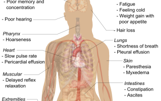 Hypothyroidism